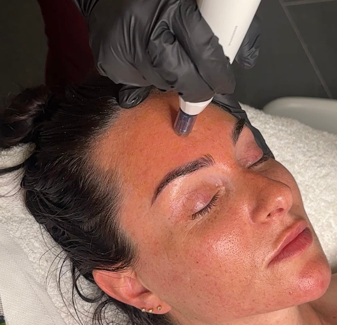 Deluxe Skin Needling & Heal-Lite Therapy